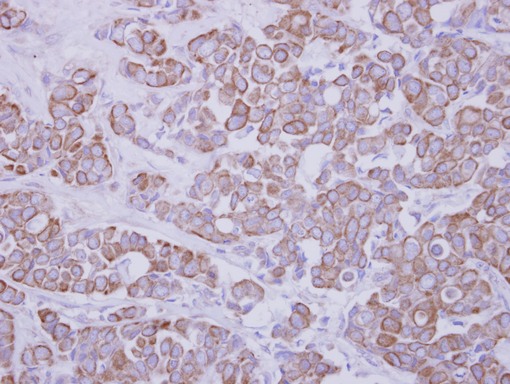 GTDC1 Antibody - IHC of paraffin-embedded Breast ca, using GTDC1 antibody antibody at 1:250 dilution.