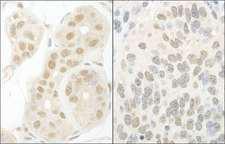 GTF2A1 / TFIIA Antibody - Detection of Human and Mouse GTF2A1/TFIIA by Immunohistochemistry. Sample: FFPE section of human breast carcinoma (left) and mouse teratoma (right). Antibody: Affinity purified rabbit anti-GTF2A1/TFIIA used at a dilution of 1:1000 (1 ug/ml). Detection: DAB.