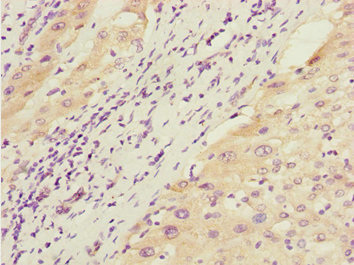 GTF2A2 / TFIIA Antibody - Immunohistochemistry of paraffin-embedded human liver cancer at dilution 1:100