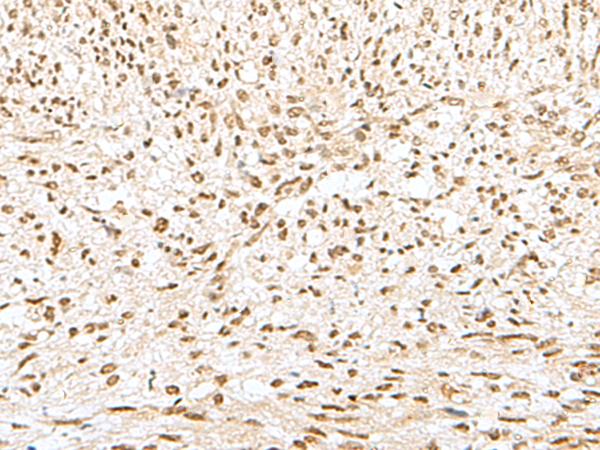 GTF2A2 / TFIIA Antibody - Immunohistochemistry of paraffin-embedded Human liver cancer tissue  using GTF2A2 Polyclonal Antibody at dilution of 1:30(×200)