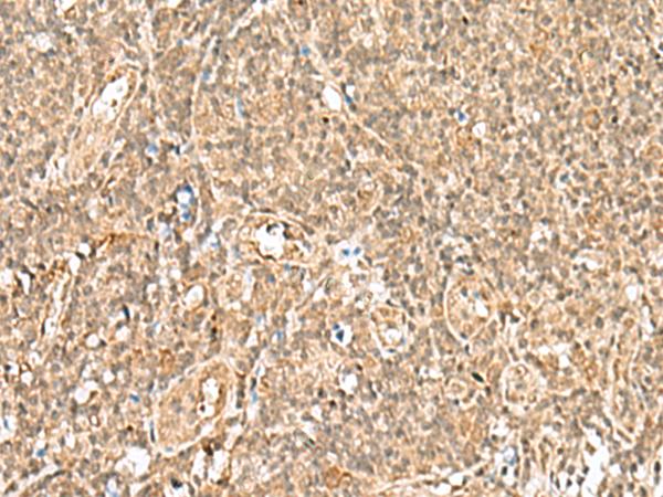 GTF2A2 / TFIIA Antibody - Immunohistochemistry of paraffin-embedded Human tonsil tissue  using GTF2A2 Polyclonal Antibody at dilution of 1:30(×200)