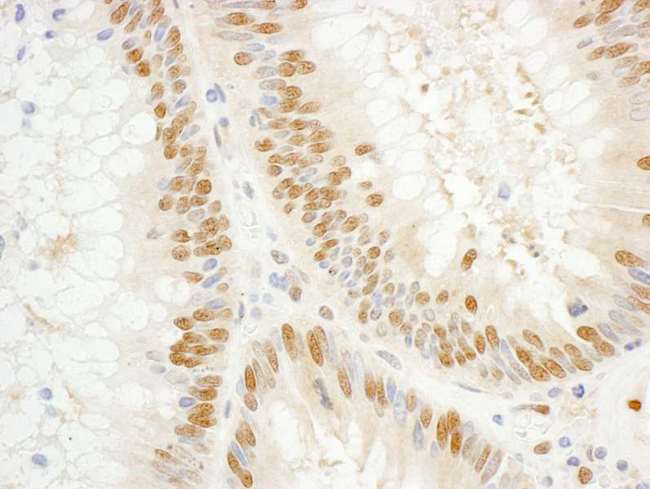 GTF2E1 Antibody - Detection of Human GTF2E1/TFIIE-alpha by Immunohistochemistry. Sample: FFPE section of human colon carcinoma. Antibody: Affinity purified rabbit anti-GTF2E1/TFIIE-alpha used at a dilution of 1:1000 (1 ug/ml). Detection: DAB.