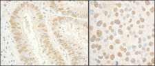 GTF2E1 Antibody - Detection of Human and Mouse GTF2E1/TFIIE-alpha by Immunohistochemistry. Sample: FFPE section of human colon carcinoma (left) and mouse renal cell carcinoma (right). Antibody: Affinity purified rabbit anti-GTF2E1/TFIIE-alpha used at a dilution of 1:200 (1 ug/ml). Detection: DAB.