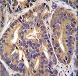 GTF2H2C Antibody - GTF2H2C Antibody immunohistochemistry of formalin-fixed and paraffin-embedded human prostate carcinoma followed by peroxidase-conjugated secondary antibody and DAB staining.