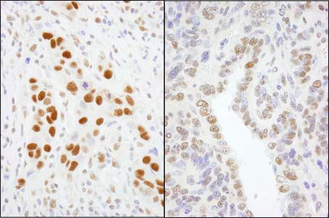 GTF2I / TFII I Antibody - Detection of Human and Mouse GTF2I/TFII-I by Immunohistochemistry. Sample: FFPE section of human breast carcinoma (left) and mouse teratoma (right). Antibody: Affinity purified rabbit anti-GTF2I/TFII-I used at a dilution of 1:200 (1 Detection: DAB.