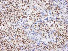 GTF2I / TFII I Antibody - Detection of Human GTF2I/TFII-I by Immunohistochemistry. Sample: FFPE section of human breast adenocarcinoma. Antibody: Affinity purified rabbit anti-GTF2I/TFII-I used at a dilution of 1:100.