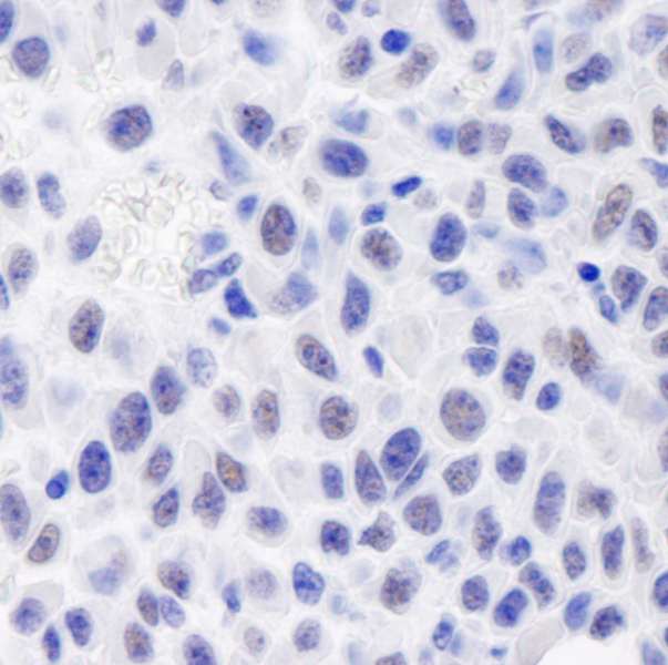 GTF2I / TFII I Antibody - Detection of Mouse GTF2I/TFII-I by Immunohistochemistry. Sample: FFPE section of mouse squamous cell carcinoma. Antibody: Affinity purified rabbit anti-GTF2I/TFII-I used at a dilution of 1:250.