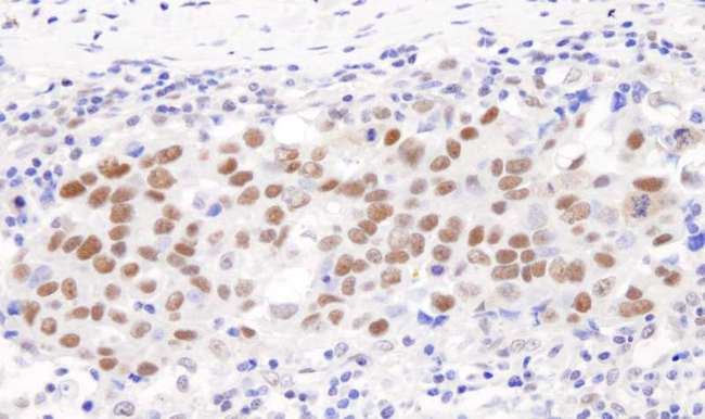GTF2I / TFII I Antibody - Detection of Human GFT2I/TFII-I by Immunohistochemistry. Sample: FFPE section of human breast carcinoma. Antibody: Affinity purified rabbit anti-GFT2I/TF II-I used at a dilution of 1:5000 (0.2 Detection: DAB.