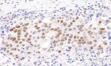 GTF2I / TFII I Antibody - Detection of Human GFT2I/TFII-I by Immunohistochemistry. Sample: FFPE section of human breast carcinoma. Antibody: Affinity purified rabbit anti-GFT2I/TF II-I used at a dilution of 1:5000 (0.2 Detection: DAB.