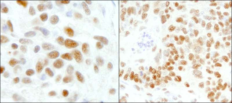 GTF2I / TFII I Antibody - Detection of Human and Mouse GTF2I/TFII-I by Immunohistochemistry. Sample: FFPE section of human Ewing sarcoma (left) and mouse teratoma (right). Antibody: Affinity purified rabbit anti-GTF2I/TFII-I used at a dilution of 1:200 (1 Detection: DAB.