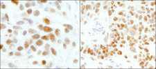 GTF2I / TFII I Antibody - Detection of Human and Mouse GTF2I/TFII-I by Immunohistochemistry. Sample: FFPE section of human Ewing sarcoma (left) and mouse teratoma (right). Antibody: Affinity purified rabbit anti-GTF2I/TFII-I used at a dilution of 1:200 (1 Detection: DAB.