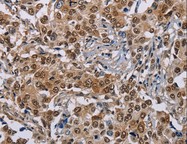GTF2I / TFII I Antibody - Immunohistochemistry of paraffin-embedded Human liver cancer using GTF2I Polyclonal Antibody at dilution of 1:40.