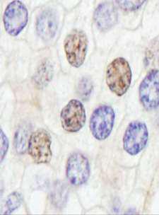 GTF3 / GTF2IRD1 Antibody - Detection of Human GTF2IRD/TFII-IRD1 by Immunohistochemistry. Sample: FFPE section of human prostate carcinoma. Antibody: Affinity purified rabbit anti-GTF2IRD/TFII-IRD1 used at a dilution of 1:5000 (0.2 Detection: DAB.
