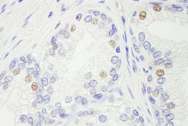 GTF3 / GTF2IRD1 Antibody - Detection of Human GTF2IRD/TFII-IRD1 by Immunohistochemistry. Sample: FFPE section of human prostate carcinoma. Antibody: Affinity purified rabbit anti-GTF2IRD/TFII-IRD1 used at a dilution of 1:200 (1 Detection: DAB.