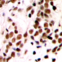 GTF3 / GTF2IRD1 Antibody - Immunohistochemical analysis of GTF2IRD1 staining in human breast cancer formalin fixed paraffin embedded tissue section. The section was pre-treated using heat mediated antigen retrieval with sodium citrate buffer (pH 6.0). The section was then incubated with the antibody at room temperature and detected with HRP and DAB as chromogen. The section was then counterstained with hematoxylin and mounted with DPX.