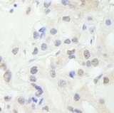GTF3C1 Antibody - Detection of Human GTF3C1/TFIIIC220 by Immunohistochemistry. Sample: FFPE section of human thyroid carcinoma. Antibody: Affinity purified rabbit anti-GTF3C1/TFIIIC220 used at a dilution of 1:250.