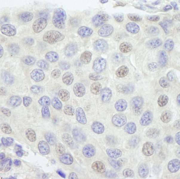 GTF3C1 Antibody - Detection of Human GTF3C1/TFIIIC220 by Immunohistochemistry. Sample: FFPE section of human breast carcinoma. Antibody: Affinity purified rabbit anti-GTF3C1/TFIIIC220 used at a dilution of 1:250.