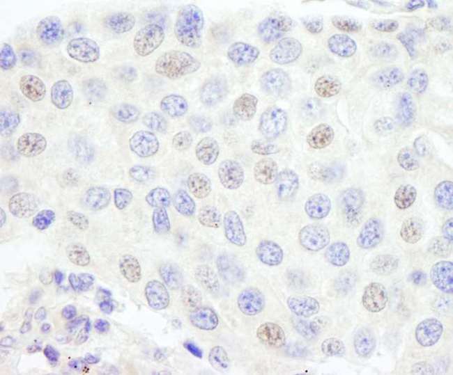GTF3C1 Antibody - Detection of Human GTF3C1/TFIIIC220 by Immunohistochemistry. Sample: FFPE section of human prostate carcinoma. Antibody: Affinity purified rabbit anti-GTF3C1/TFIIIC220 used at a dilution of 1:1000 (1 Detection: DAB.