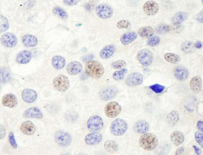 GTF3C1 Antibody - Detection of Human GTF3C1/TFIIIC220 by Immunohistochemistry. Sample: FFPE section of human prostate carcinoma. Antibody: Affinity purified rabbit anti-GTF3C1/TFIIIC220 used at a dilution of 1:5000 (0.2 Detection: DAB.