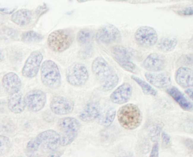 GTF3C2 Antibody - Detection of Human GTF3C2/TFIIIC110 by Immunohistochemistry. Sample: FFPE section of human breast carcinoma. Antibody: Affinity purified rabbit anti-GTF3C2/TFIIIC110 used at a dilution of 1:1000 (1 ug/ml). Detection: DAB.