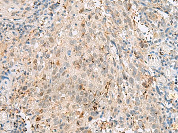 GTF3C2 Antibody - Immunohistochemistry of paraffin-embedded Human cervical cancer tissue  using GTF3C2 Polyclonal Antibody at dilution of 1:45(×200)