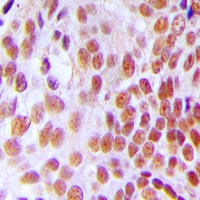GTF3C2 Antibody - Immunohistochemical analysis of GTF3C2 staining in human breast cancer formalin fixed paraffin embedded tissue section. The section was pre-treated using heat mediated antigen retrieval with sodium citrate buffer (pH 6.0). The section was then incubated with the antibody at room temperature and detected using an HRP polymer system. DAB was used as the chromogen. The section was then counterstained with hematoxylin and mounted with DPX.