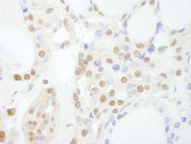 GTF3C3 Antibody - Detection of Human GTF3C3/TFIIIC102 by Immunohistochemistry. Sample: FFPE section of human thyroid carcinoma. Antibody: Affinity purified rabbit anti-GTF3C3/TFIIIC102 used at a dilution of 1:100.