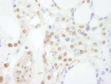 GTF3C3 Antibody - Detection of Human GTF3C3/TFIIIC102 by Immunohistochemistry. Sample: FFPE section of human thyroid carcinoma. Antibody: Affinity purified rabbit anti-GTF3C3/TFIIIC102 used at a dilution of 1:100.