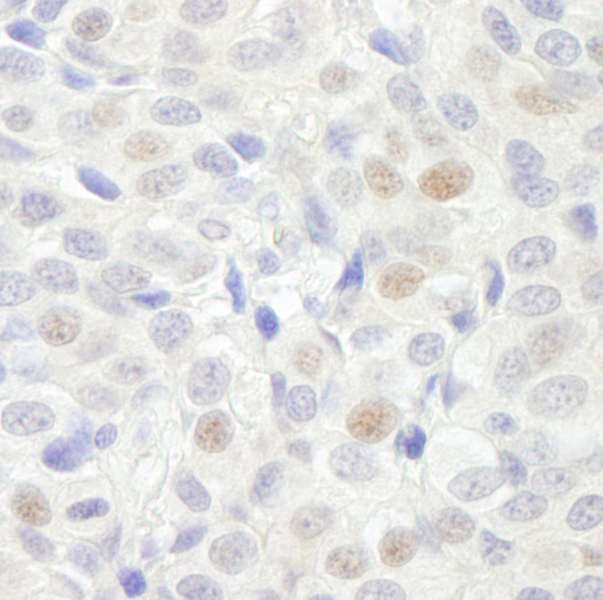 GTF3C3 Antibody - Detection of Human GTF3C3/TFIIIC102 by Immunohistochemistry. Sample: FFPE section of human breast carcinoma. Antibody: Affinity purified rabbit anti-GTF3C3/TFIIIC102 used at a dilution of 1:500.
