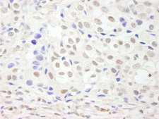 GTF3C3 Antibody - Detection of Human GTF3C3/TFIIIC102 by Immunohistochemistry. Sample: FFPE section of human breast carcinoma. Antibody: Affinity purified rabbit anti-GTF3C3/TFIIIC102 used at a dilution of 1:500 (0.4 ug/ml). Detection: DAB.