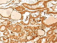 GTF3C3 Antibody - Immunohistochemistry of paraffin-embedded Human thyroid cancer tissue  using GTF3C3 Polyclonal Antibody at dilution of 1:30(×200)