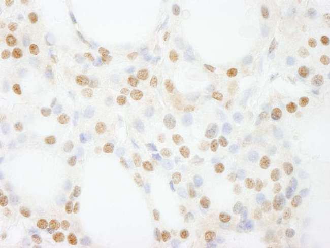 GTF3C4 Antibody - Detection of Human GTF3C4/TFIIIC90 by Immunohistochemistry. Sample: FFPE section of human thyroid carcinoma. Antibody: Affinity purified rabbit anti-GTF3C4/TFIIIC90 used at a dilution of 1:200 (1 ug/ml). Detection: DAB.