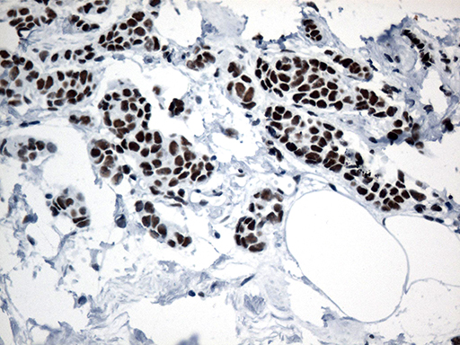 GTF3C4 Antibody - Immunohistochemical staining of paraffin-embedded Adenocarcinoma of Human breast tissue tissue using anti-GTF3C4 mouse monoclonal antibody. (Heat-induced epitope retrieval by 1mM EDTA in 10mM Tris buffer. (pH8.5) at 120°C for 3 min. (1:500)