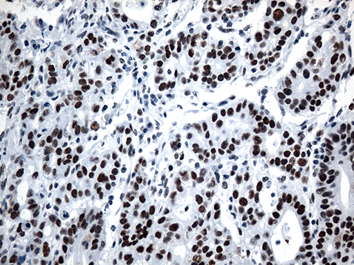 GTF3C4 Antibody - Immunohistochemical staining of paraffin-embedded Human Gastric Carcinoma using anti-GTF3C4 mouse monoclonal antibody. (Heat-induced epitope retrieval by 1mM EDTA in 10mM Tris buffer. (pH8.5) at 120°C for 3 min. (1:500)