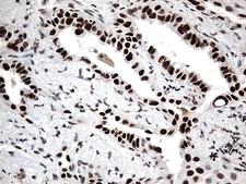 GTF3C4 Antibody - Immunohistochemical staining of paraffin-embedded Carcinoma of Human lung tissue using anti-GTF3C4 mouse monoclonal antibody. (Heat-induced epitope retrieval by 1mM EDTA in 10mM Tris buffer. (pH8.5) at 120°C for 3 min. (1:500)
