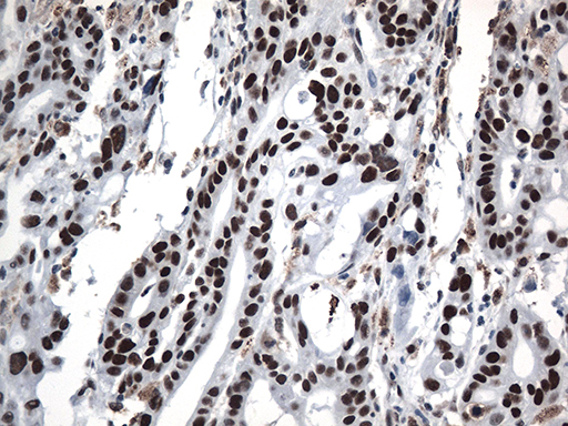 GTF3C4 Antibody - Immunohistochemical staining of paraffin-embedded Human Gastric Carcinoma using anti-GTF3C4 mouse monoclonal antibody. (Heat-induced epitope retrieval by 1mM EDTA in 10mM Tris buffer. (pH8.5) at 120°C for 3 min. (1:500)