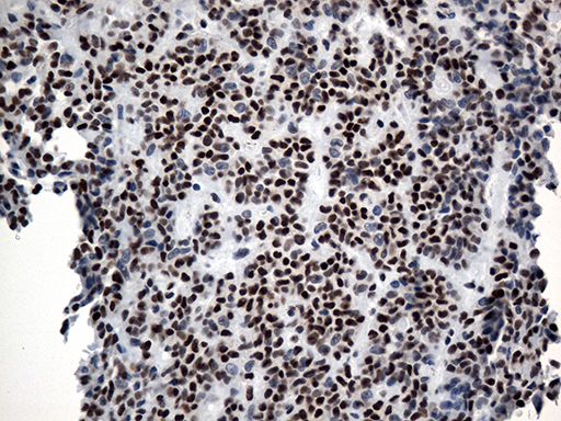 GTF3C4 Antibody - Immunohistochemical staining of paraffin-embedded Carcinoma of Human pancreas tissue using anti-GTF3C4 mouse monoclonal antibody. (Heat-induced epitope retrieval by 1mM EDTA in 10mM Tris buffer. (pH8.5) at 120°C for 3 min. (1:500)