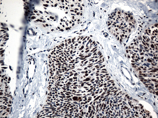 GTF3C4 Antibody - Immunohistochemical staining of paraffin-embedded Carcinoma of Human thyroid tissue using anti-GTF3C4 mouse monoclonal antibody. (Heat-induced epitope retrieval by 1mM EDTA in 10mM Tris buffer. (pH8.5) at 120°C for 3 min. (1:500)
