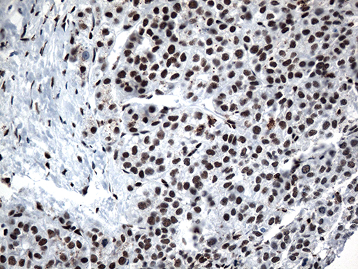 GTF3C4 Antibody - Immunohistochemical staining of paraffin-embedded Carcinoma of Human liver tissue using anti-GTF3C4 mouse monoclonal antibody. (Heat-induced epitope retrieval by 1mM EDTA in 10mM Tris buffer. (pH8.5) at 120°C for 3 min. (1:500)