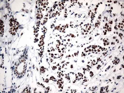 GTF3C4 Antibody - Immunohistochemical staining of paraffin-embedded Adenocarcinoma of Human breast tissue tissue using anti-GTF3C4 mouse monoclonal antibody. (Heat-induced epitope retrieval by 1mM EDTA in 10mM Tris buffer. (pH8.5) at 120°C for 3 min. (1:750)