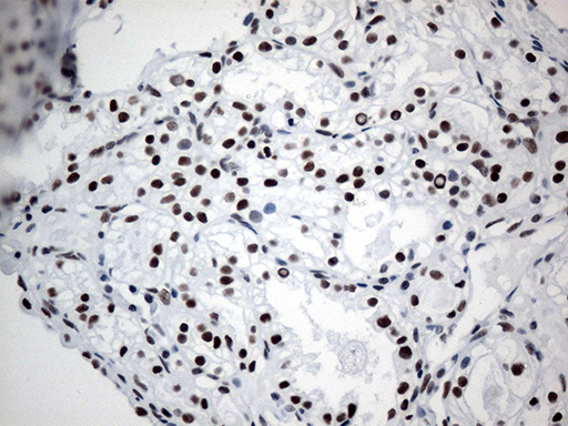 GTF3C4 Antibody - Immunohistochemical staining of paraffin-embedded Carcinoma of Human kidney tissue using anti-GTF3C4 mouse monoclonal antibody. (Heat-induced epitope retrieval by 1mM EDTA in 10mM Tris buffer. (pH8.5) at 120°C for 3 min. (1:750)
