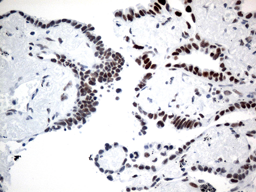GTF3C4 Antibody - Immunohistochemical staining of paraffin-embedded Carcinoma of Human lung tissue using anti-GTF3C4 mouse monoclonal antibody. (Heat-induced epitope retrieval by 1mM EDTA in 10mM Tris buffer. (pH8.5) at 120°C for 3 min. (1:750)