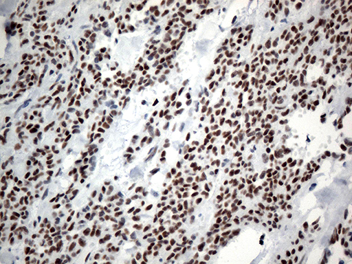 GTF3C4 Antibody - Immunohistochemical staining of paraffin-embedded Carcinoma of Human pancreas tissue using anti-GTF3C4 mouse monoclonal antibody. (Heat-induced epitope retrieval by 1mM EDTA in 10mM Tris buffer. (pH8.5) at 120°C for 3 min. (1:750)