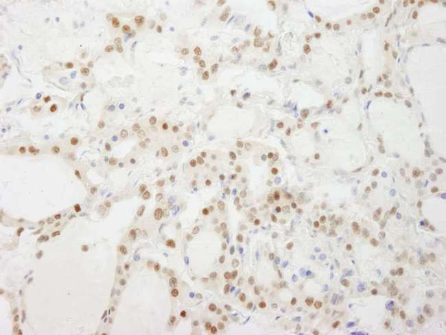 GTF3C4 Antibody - Detection of Human GTF3C4/TFIIIC90 by Immunohistochemistry. Sample: FFPE section of human thyroid carcinoma. Antibody: Affinity purified rabbit anti-GTF3C4/TFIIIC90 used at a dilution of 1:500.