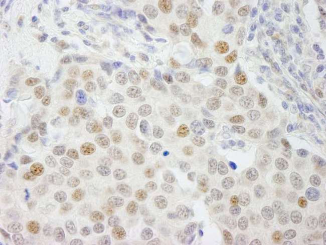 GTF3C4 Antibody - Detection of Human GTF3C4/TFIIIC90 by Immunohistochemistry. Sample: FFPE section of human breast carcinoma. Antibody: Affinity purified rabbit anti-GTF3C4/TFIIIC90 used at a dilution of 1:100.