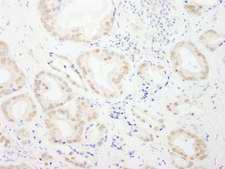 GTF3C4 Antibody - Detection of Human GTF3C4/TFIIIC90 by Immunohistochemistry. Sample: FFPE section of human prostate carcinoma. Antibody: Affinity purified rabbit anti-GTF3C4/TFIIIC90 used at a dilution of 1:5000 (0.2 ug/ml). Detection: DAB.