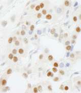 GTF3C5 Antibody - Detection of Human GTF3C5/TFIIIC63 by Immunohistochemistry. Sample: FFPE section of human thyroid carcinoma. Antibody: Affinity purified rabbit anti-GTF3C5/TFIIIC63 used at a dilution of 1:500.