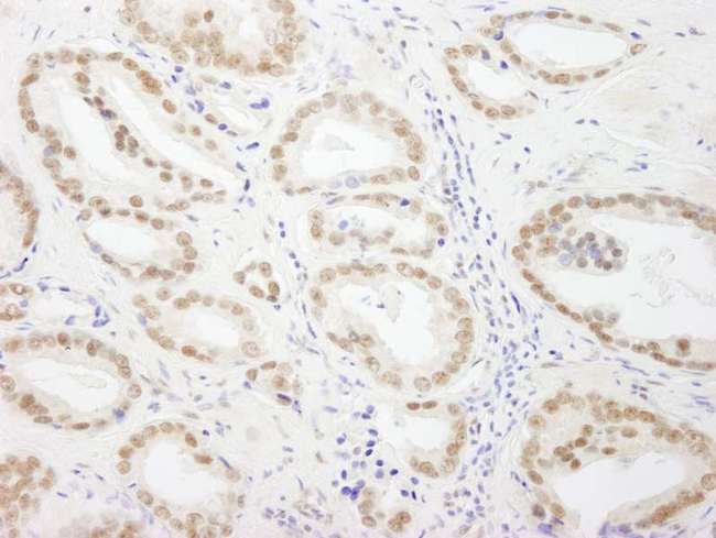 GTF3C5 Antibody - Detection of Human GTF3C5/TFIIIC63 by Immunohistochemistry. Sample: FFPE section of human prostate carcinoma. Antibody: Affinity purified rabbit anti-GTF3C5/TFIIIC63 used at a dilution of 1:500.
