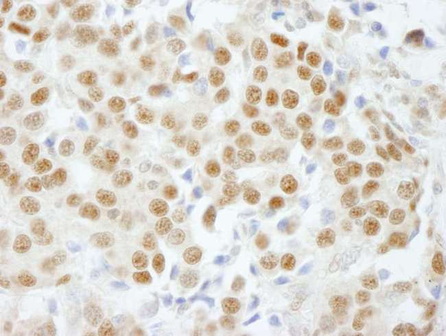 GTF3C5 Antibody - Detection of Human GTF3C5/TFIIIC63 by Immunohistochemistry. Sample: FFPE section of human breast carcinoma. Antibody: Affinity purified rabbit anti-GTF3C5/TFIIIC63 used at a dilution of 1:500.