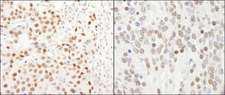 GTF3C5 Antibody - Detection of Human and Mouse GTF3C5/TFIIIC63 by Immunohistochemistry. Sample: FFPE section of human breast carcinoma (left) and mouse teratoma (right). Antibody: Affinity purified rabbit anti-GTF3C5/TFIIIC63 used at a dilution of 1:500 (0.4 ug/ml). Detection: DAB.